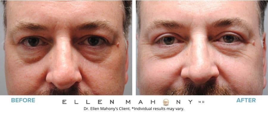 Before and After Image: Case #5500 - front