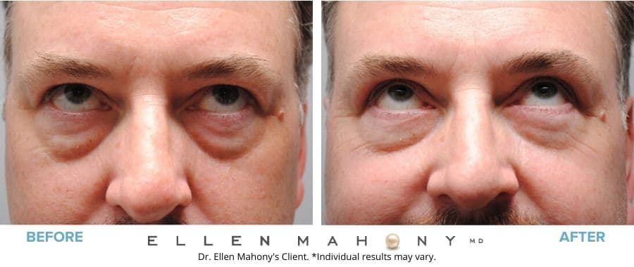 Before and After Image: Case #5500 - front