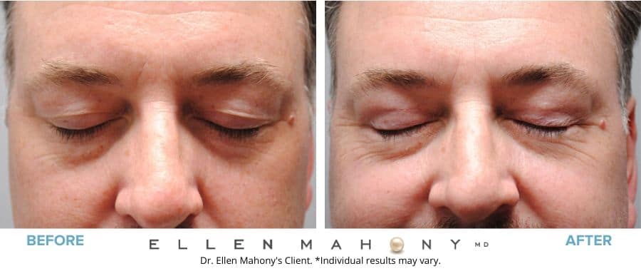 Before and After Image: Case #5500 - front