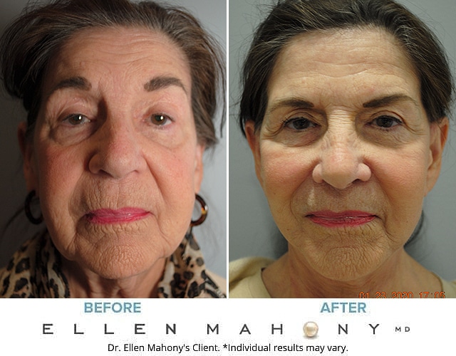 Before and After Image: Case #7310-2 - front
