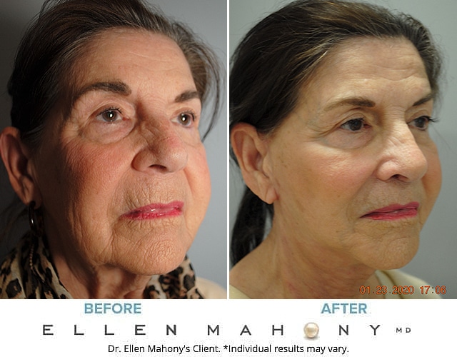 Before and After Image: Case #7310-2 - right-front-oblique
