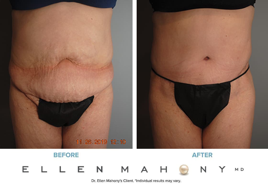 Before and After Image: Case #8581 - front