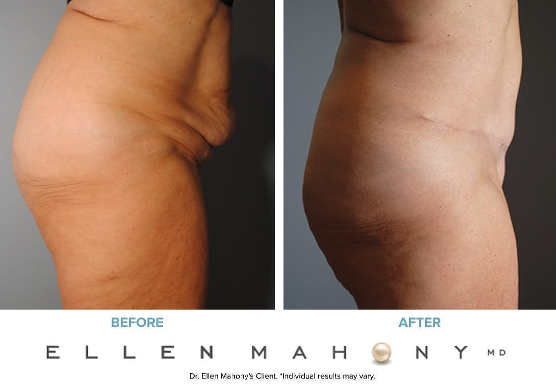 Before and After Image: Case #7681 - right-side