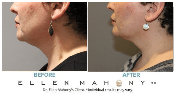 Before and After Image: Case #11969 - left-side
