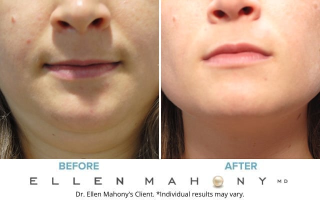 Before and After Image: Case #8955 - front
