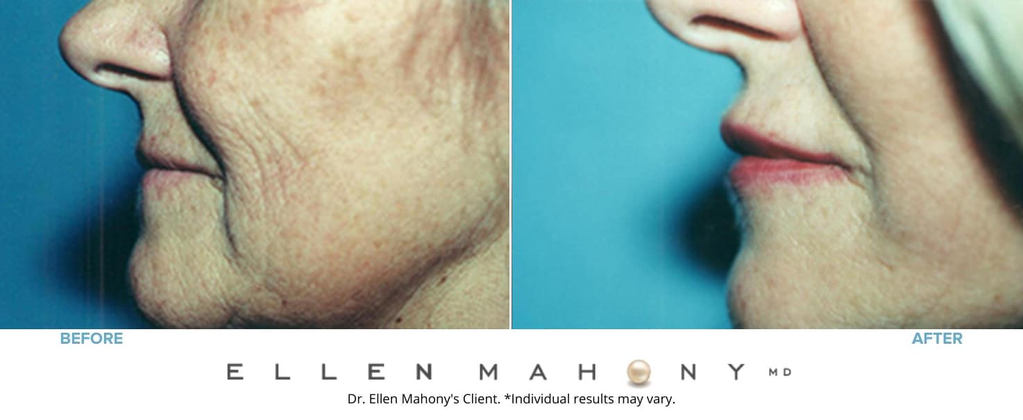 Before and After Image: Case #4883 - left-side
