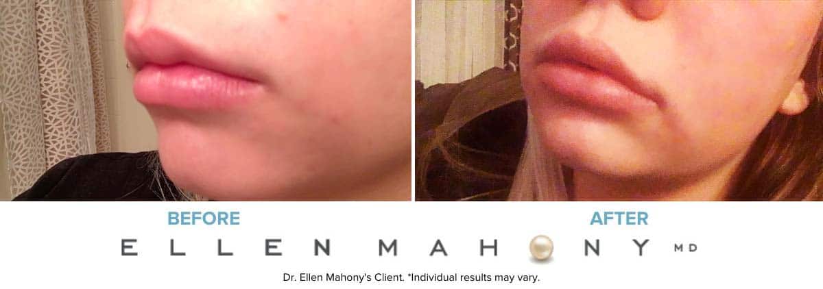 Before and After Image: Case #7371 - left-front-oblique