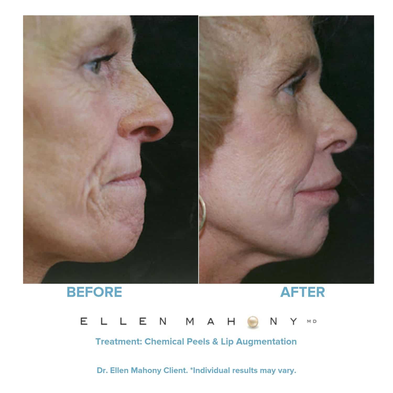 Before and After Image: Case #3360 - right-side