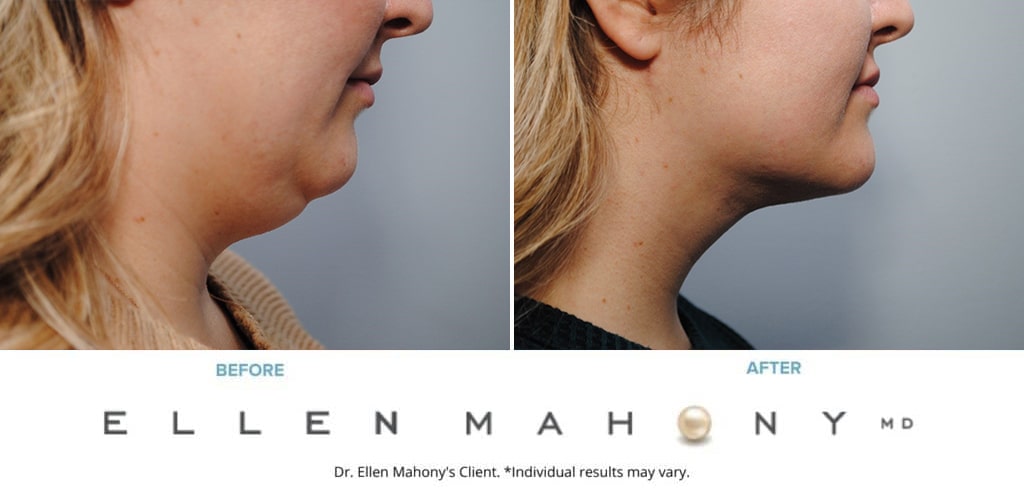 Before and After Image: Case #9536 - right-side