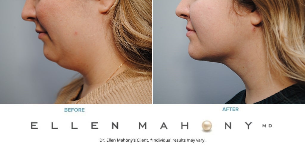Before and After Image: Case #9536 - left-side