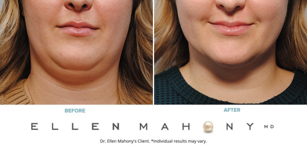 Before and After Image: Case #9536 - front