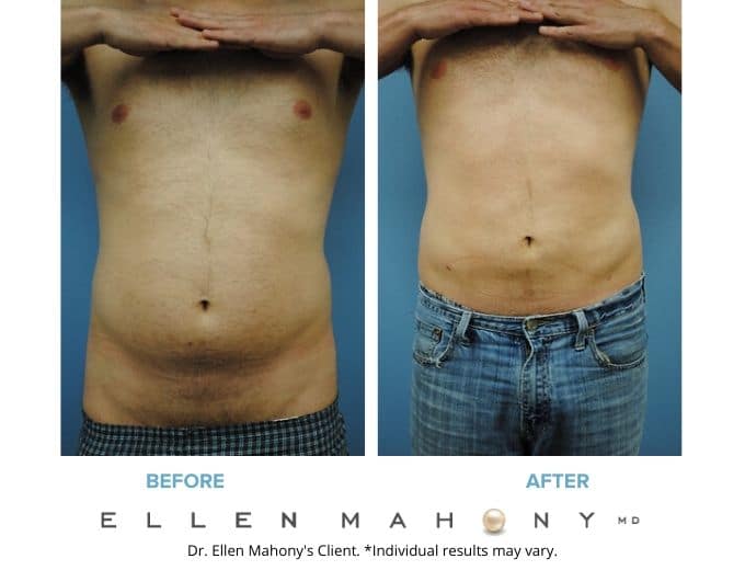 Before and After Image: Case #2134 - front