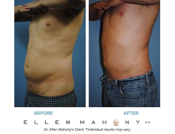 Before and After Image: Case #2134 - left-side