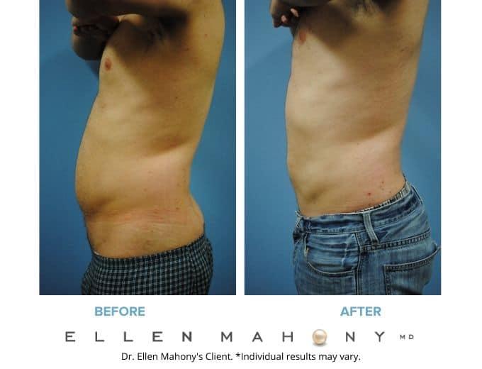 Before and After Image: Case #2134 - left-side