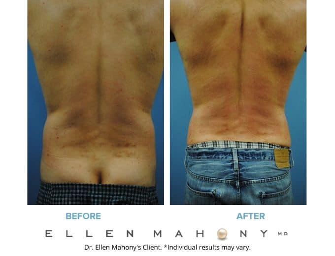 Before and After Image: Case #2134 - back