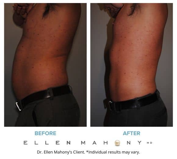 Before and After Image: Case #2155 - left-side