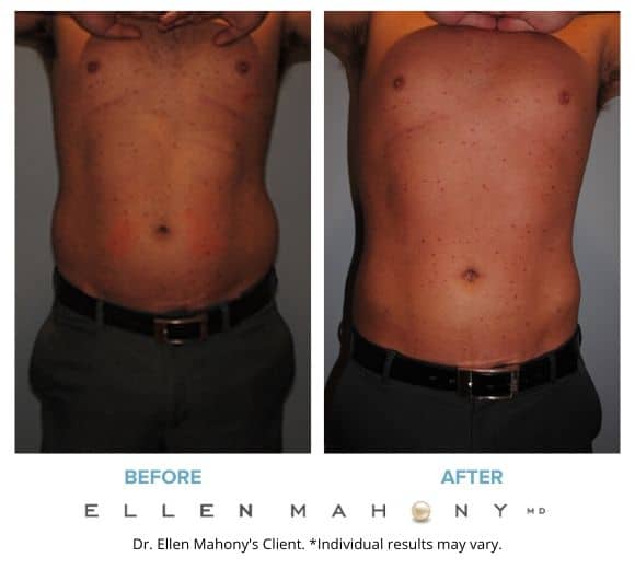 Before and After Image: Case #2155 - front