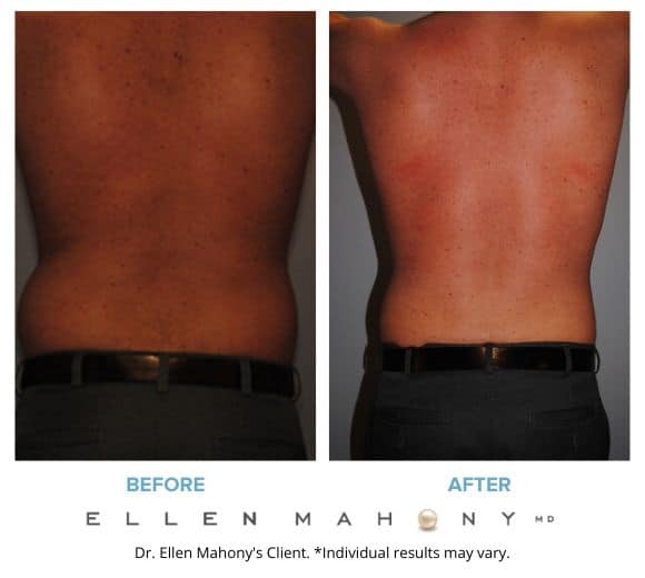 Before and After Image: Case #2155 - back