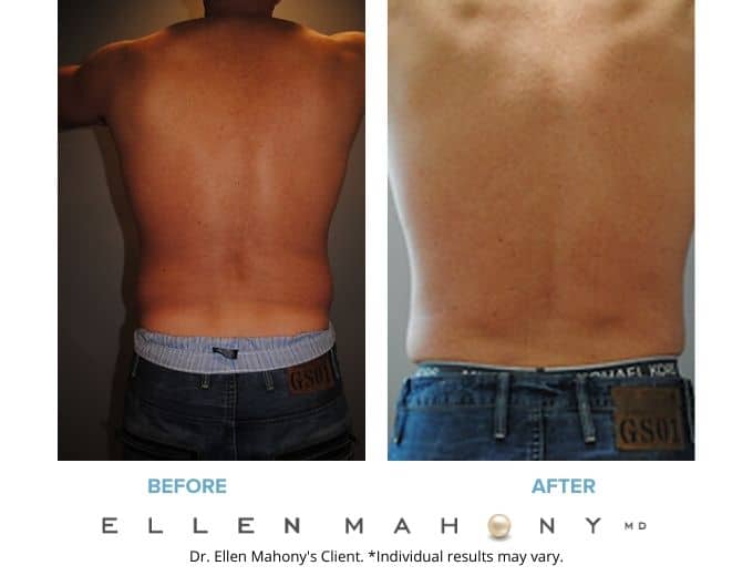 Before and After Image: Case #2186 - back