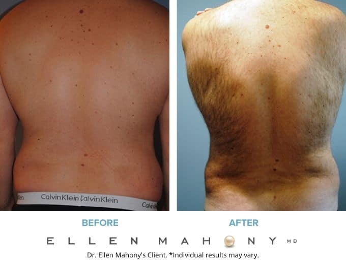 Before and After Image: Case #2203 - back