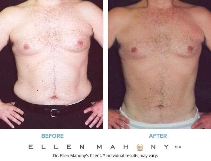 Before and After Image: Case #2279 - front
