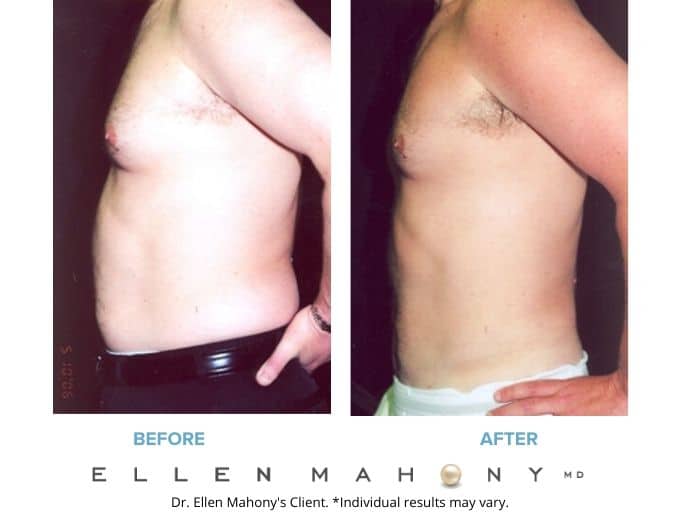 Before and After Image: Case #2279 - left-side