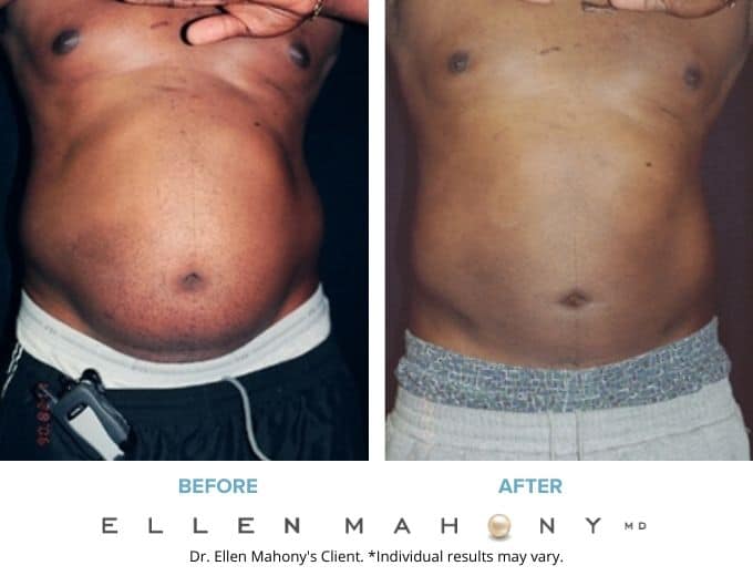 Before and After Image: Case #2286 - front
