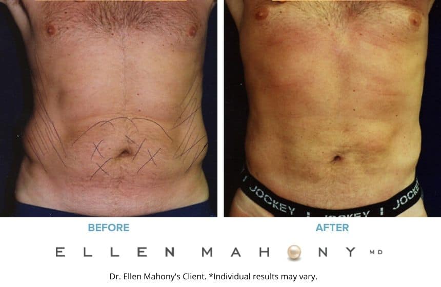 Before and After Image: Case #2358 - front