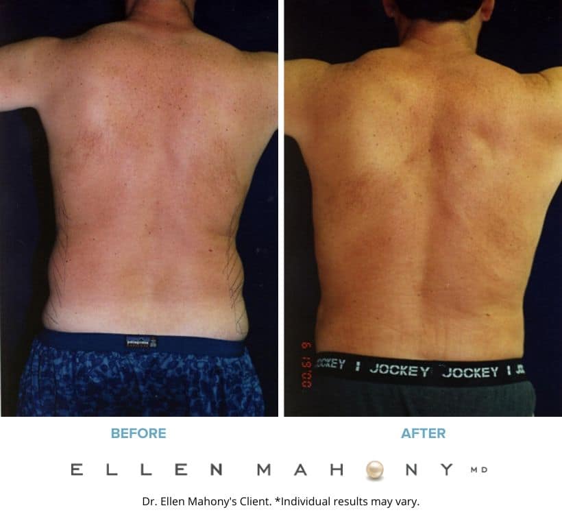 Before and After Image: Case #2358 - back