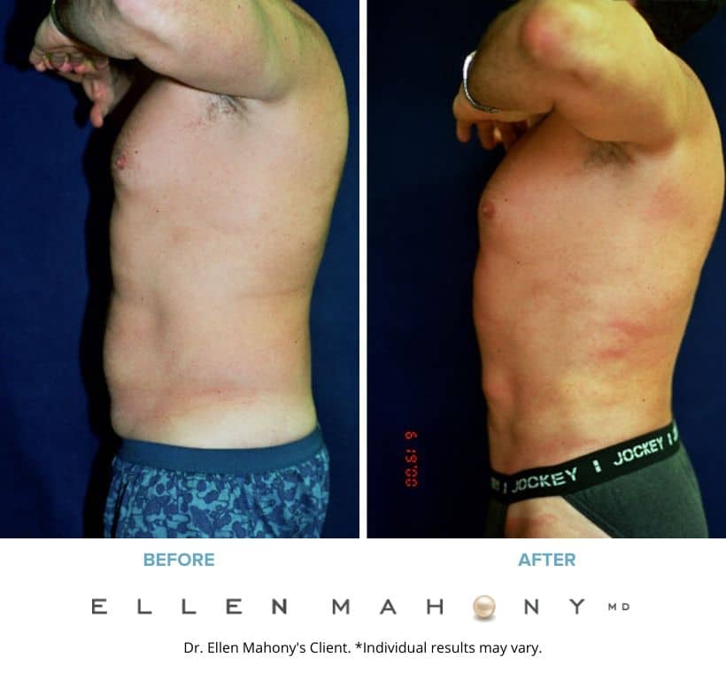 Before and After Image: Case #2358 - left-side