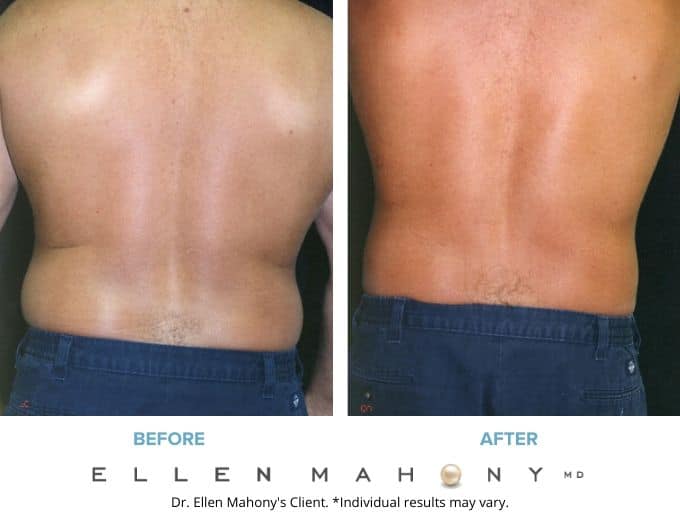 Before and After Image: Case #2372 - back