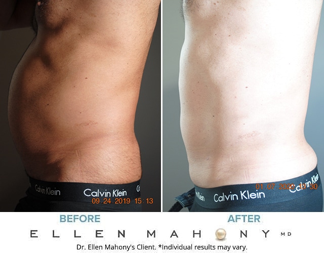 Before and After Image: Case #8577 - left-side