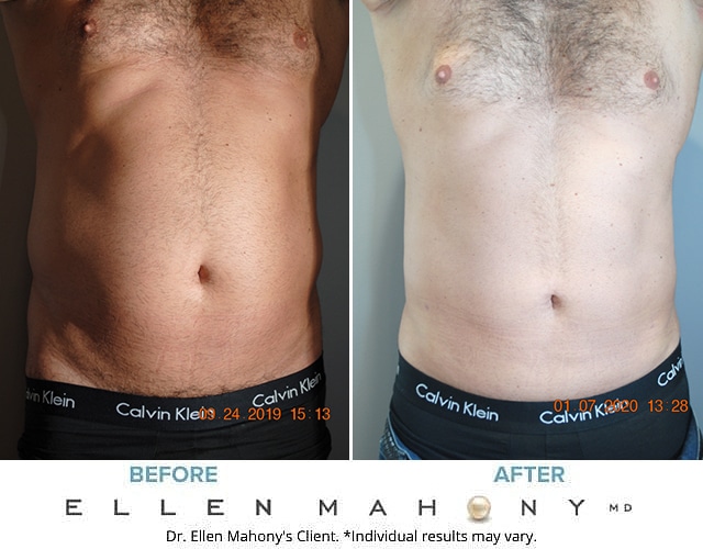 Before and After Image: Case #8577 - front