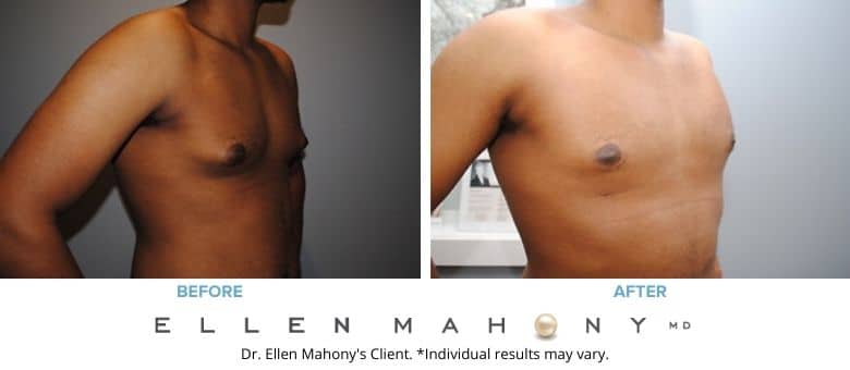 Before and After Image: Case #2542 - right-front-oblique