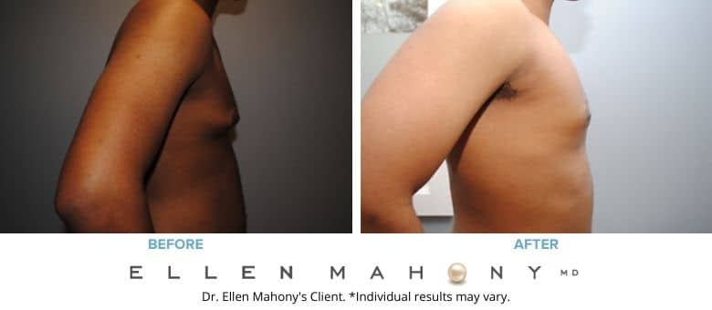Before and After Image: Case #2542 - right-side