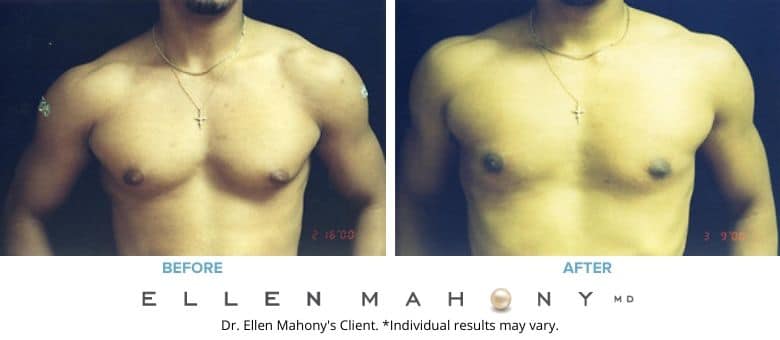 Before and After Image: Case #2549 - front