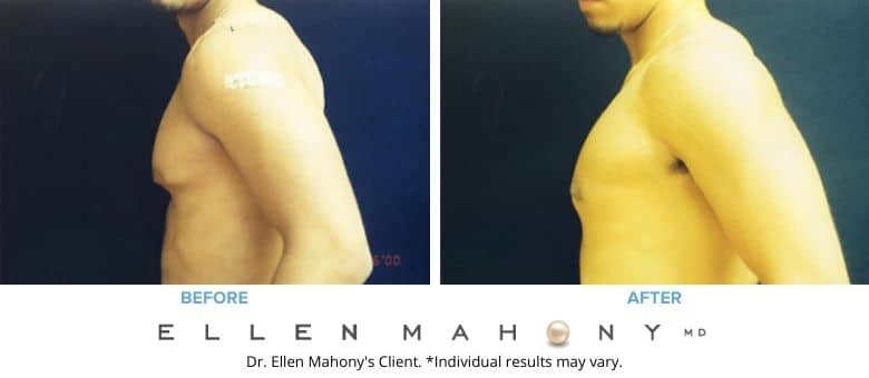 Before and After Image: Case #2549 - left-side