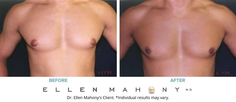 Before and After Image: Case #2556 - front