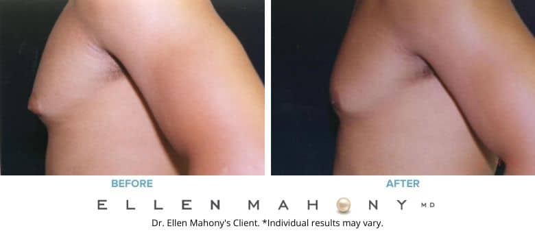Before and After Image: Case #2556 - left-side