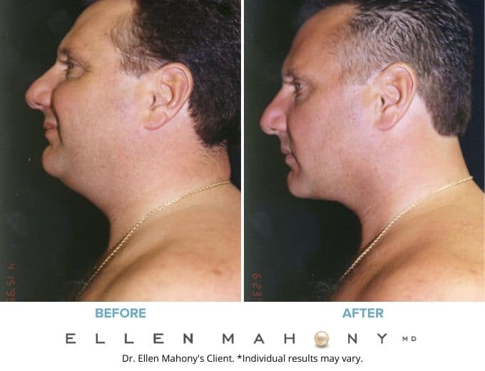 Before and After Image: Case #3365 - left-side