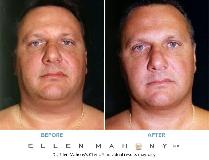 Before and After Image: Case #3365 - front