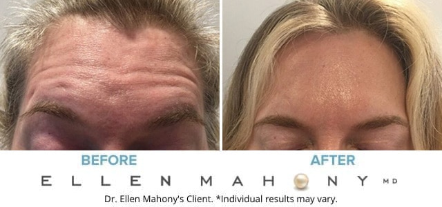 Before and After Image: Case # 6054 - front