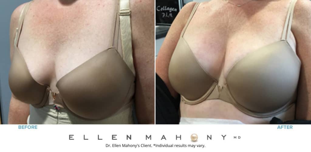 Before and After Image: Case #8375 - left-front-oblique