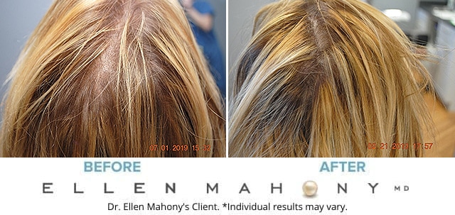 Before and After Image: Case #7970 - back