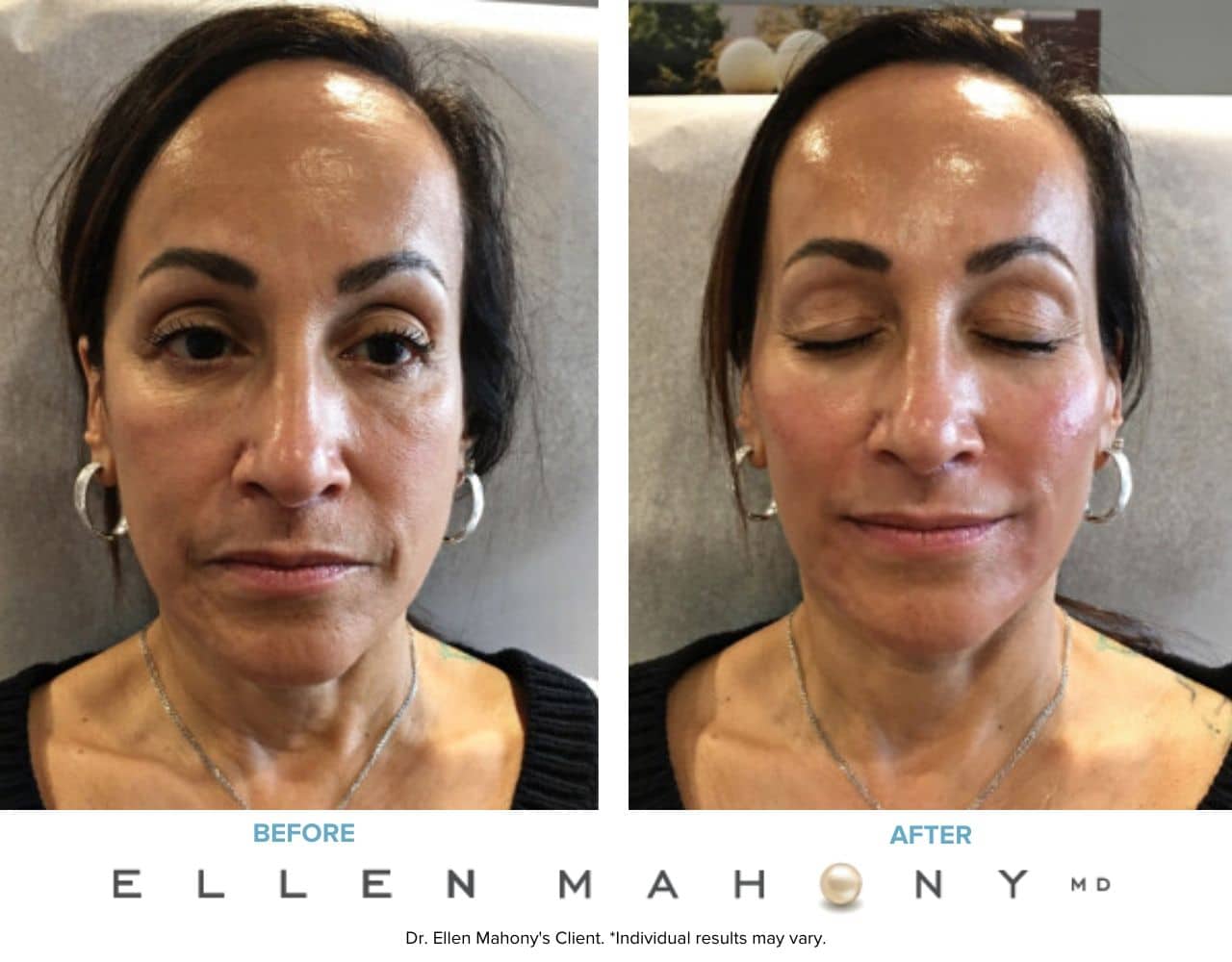 Before and After Image: Case #7609 - front