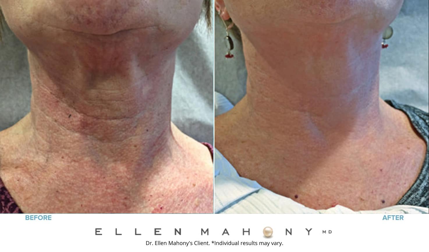 Before and After Image: Case #7558 - front