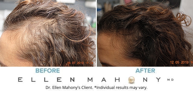Before and After Image: Case #8234 - left-side
