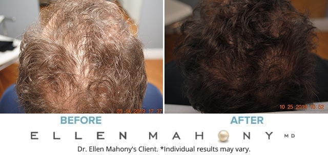 Before and After Image: Case #8210 - front