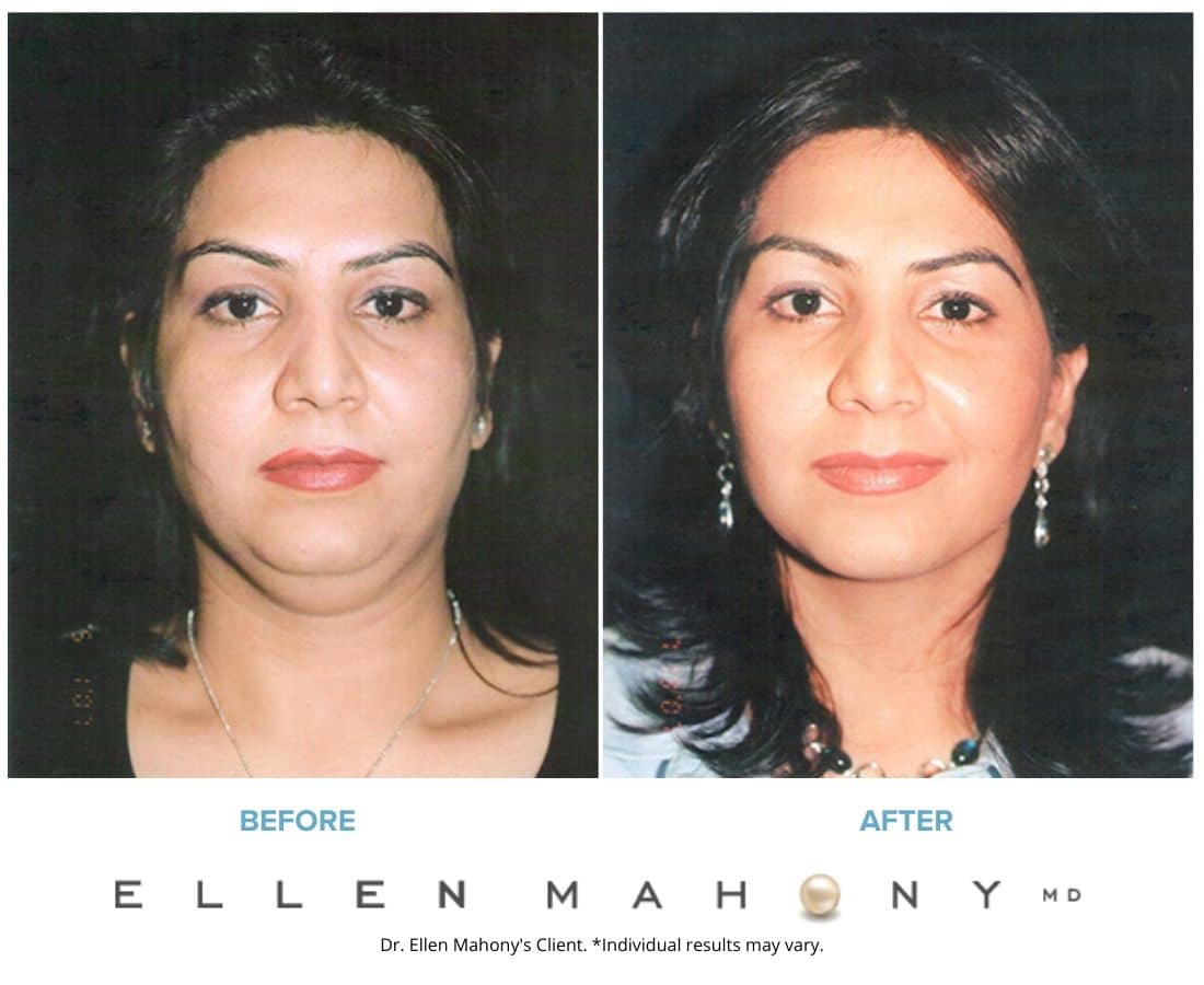 Before and After Image: Case #3228 - front