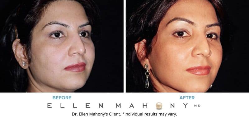 Before and After Image: Case #3228 - right-front-oblique